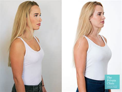 breast expension|Breast Augmentation Before and After Photos .